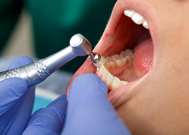 Best Root Canal Treatment  in USA